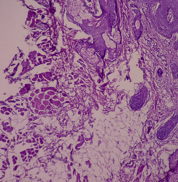 hpv