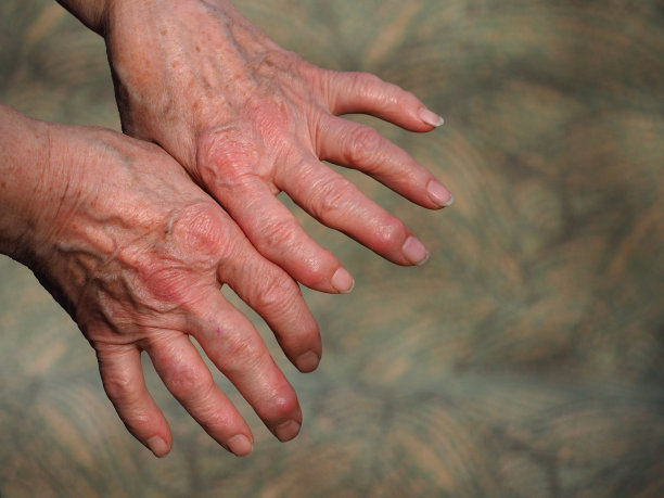 arthritis