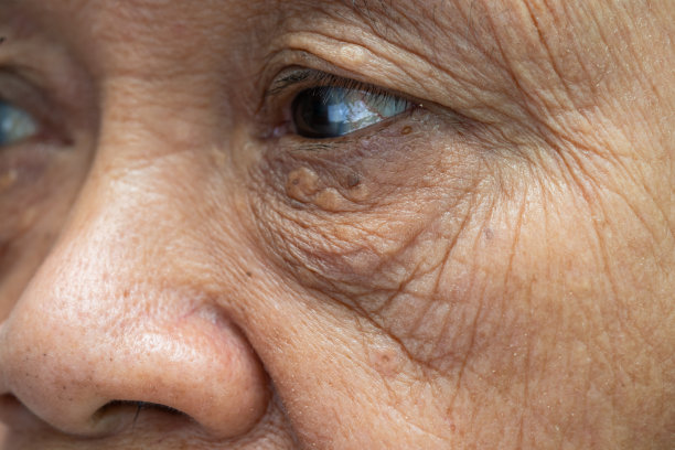 wrinkles
