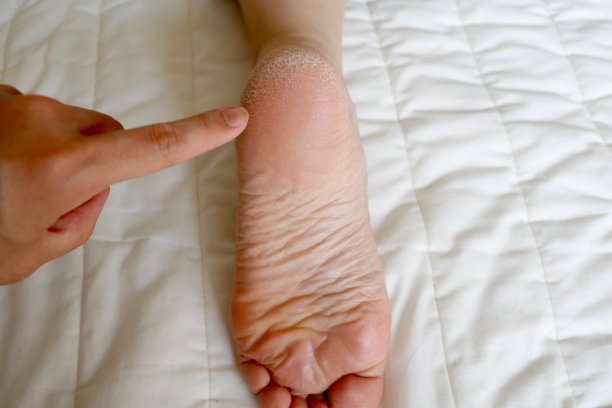 limbs
