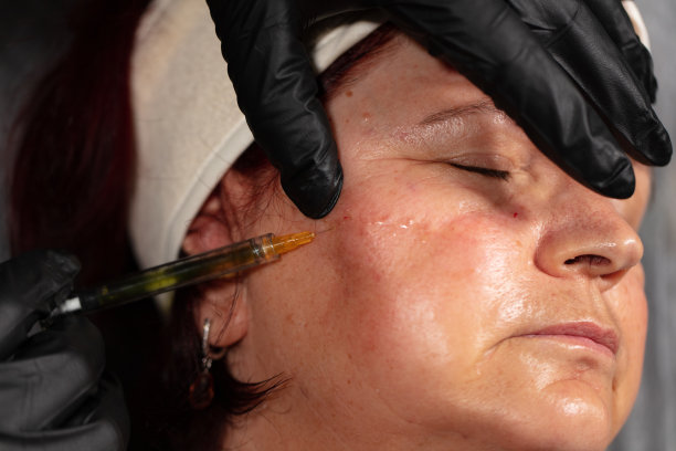 botox