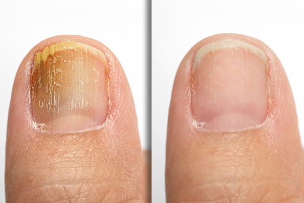 nail