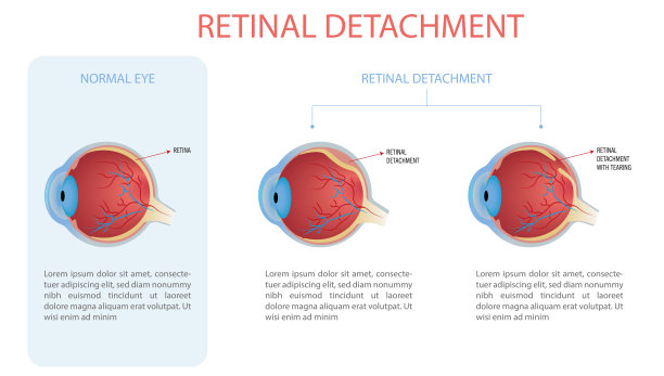 retina