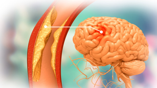 stroke