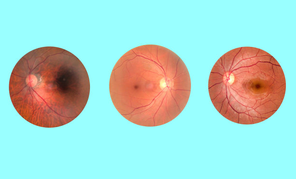 retina