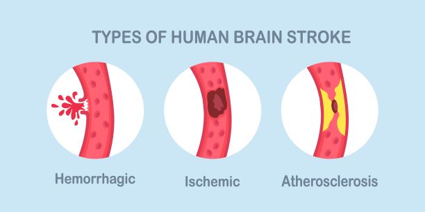 stroke