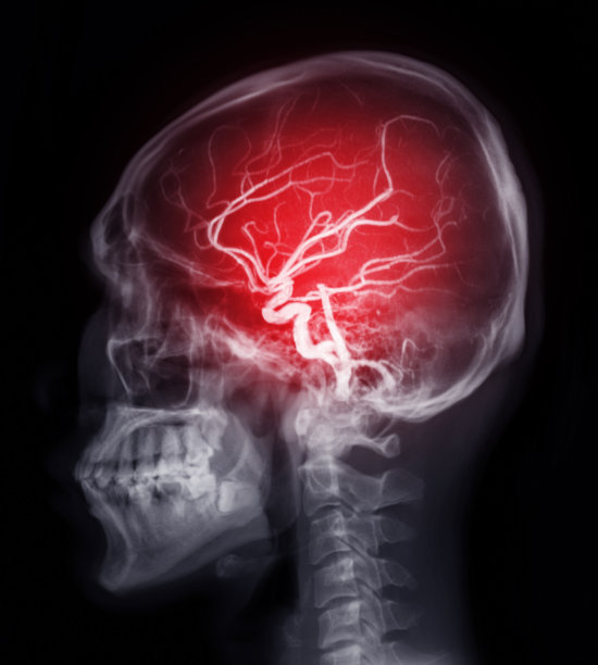 stroke