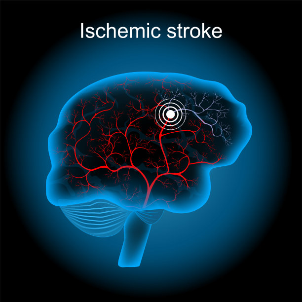 stroke