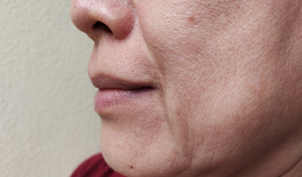 wrinkles