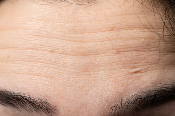 wrinkles