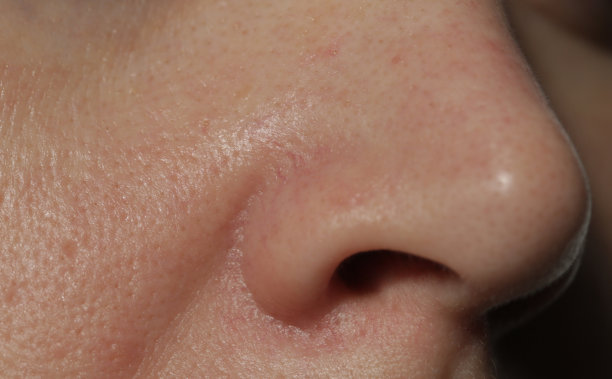 pores