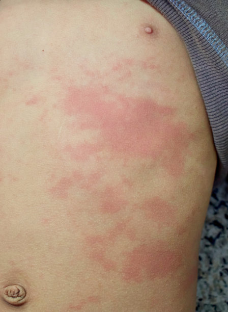 rash