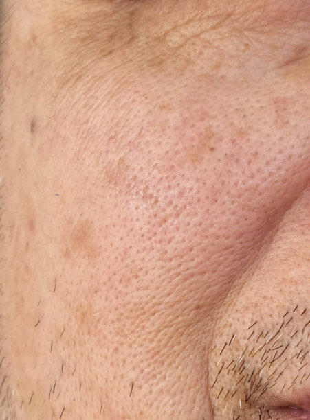 pores
