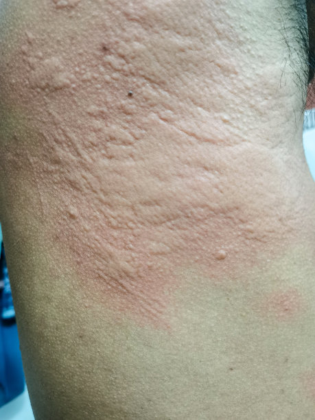 rash