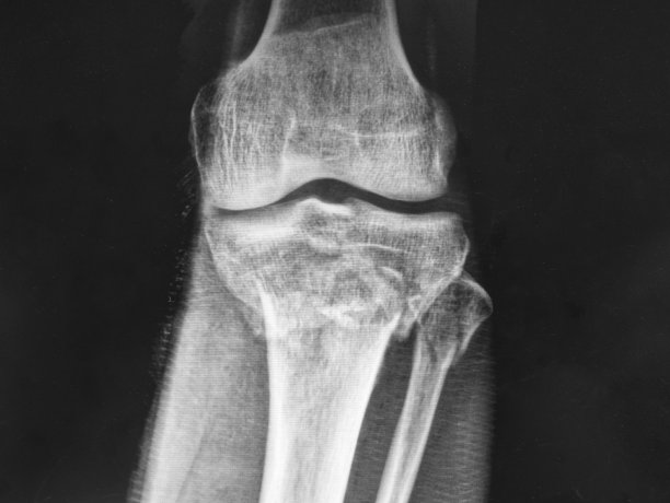 tibia