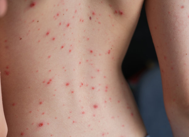 rash