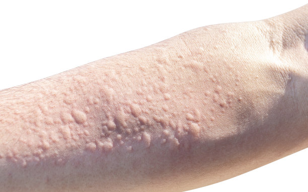 rash