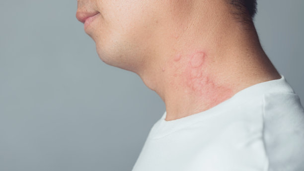 rash