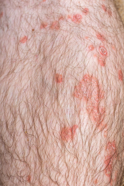 rash