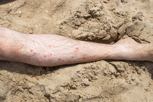 rash