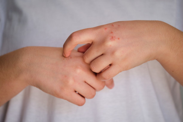 rash