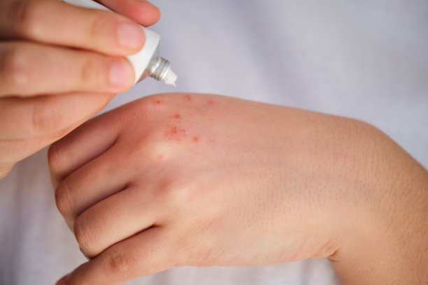 rash