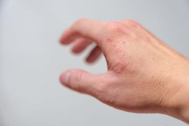 rash