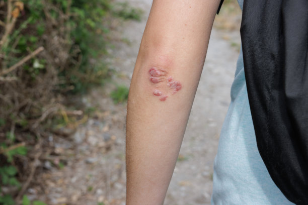 rash