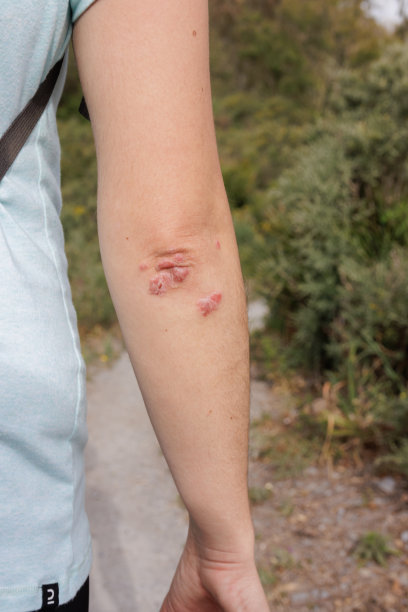 rash