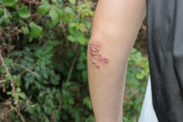 rash
