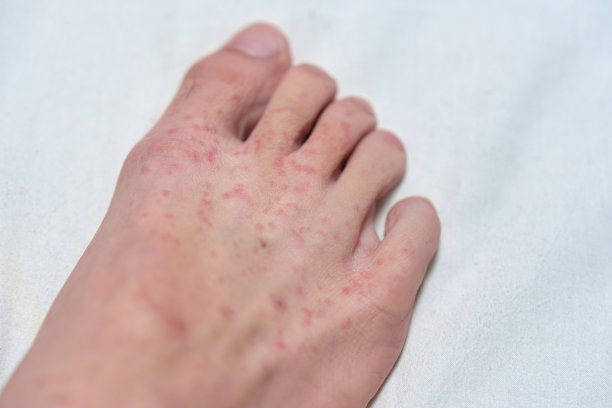 inflammation