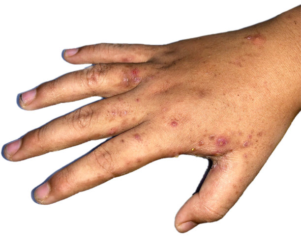 rash