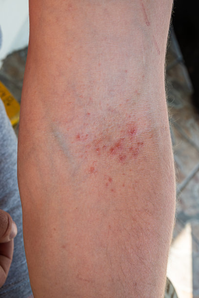 rash