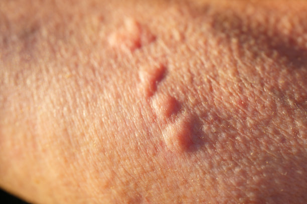 rash
