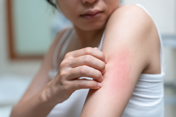 rash