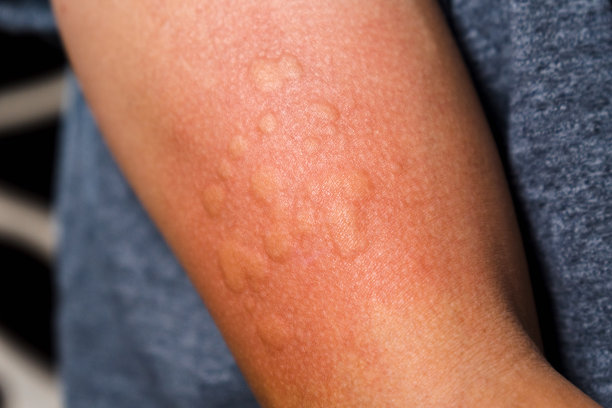 rash