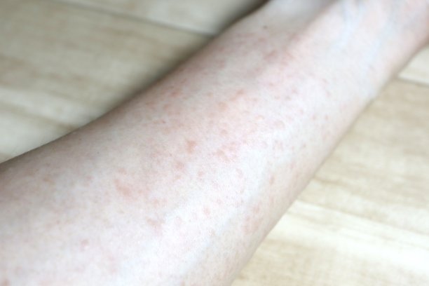 rash