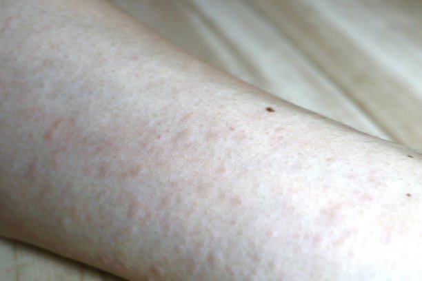 rash