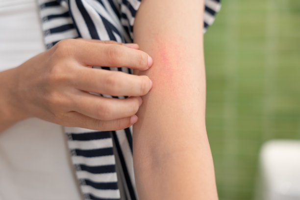 rash