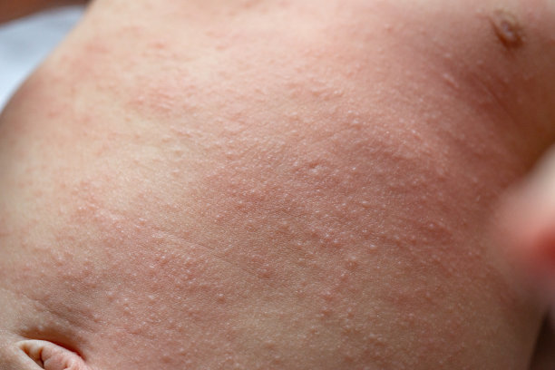 rash