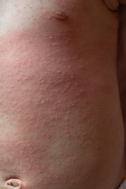 rash