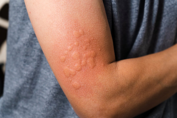 rash