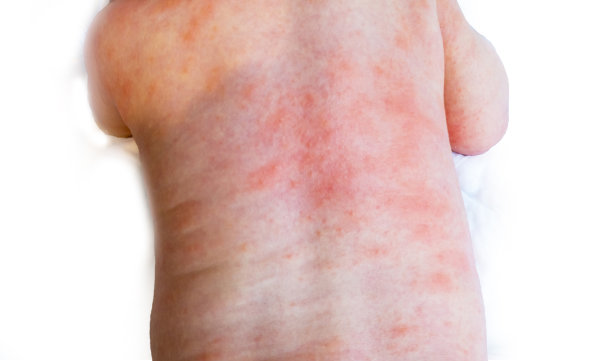 rash