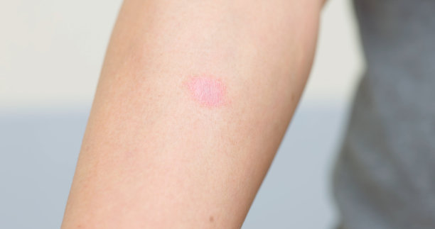 rash