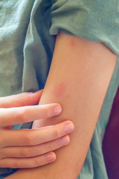 rash