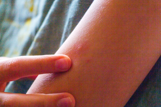 rash