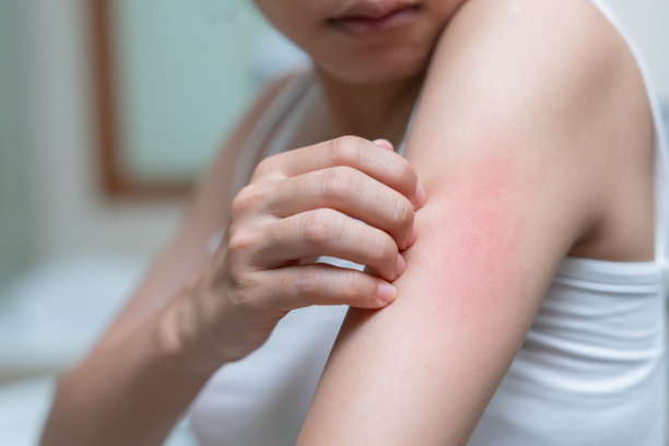 rash