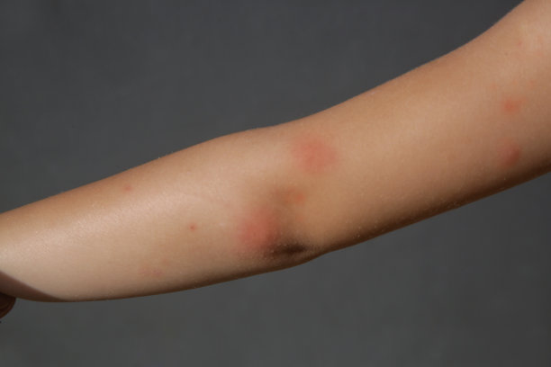 rash