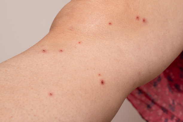 rash