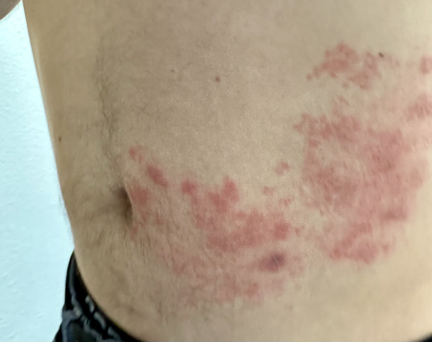 rash